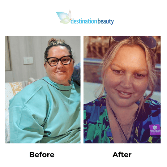 Caroline lost 12 kg 3 weeks after gastric sleeve surgery in Thailand